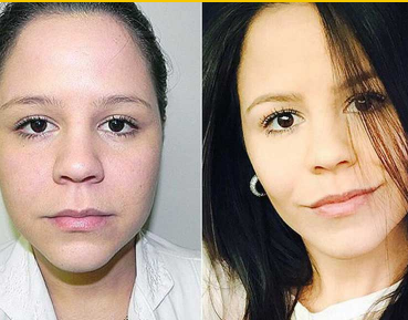 Antes e depois - Harmonização do Rosto