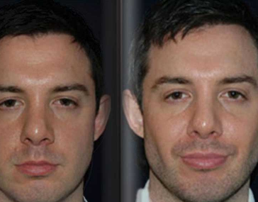 Antes e depois - Definição Facial Masculina